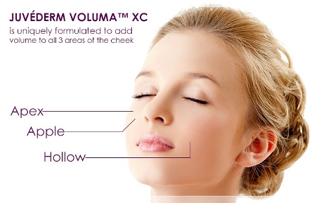 About JUVÉDERM VOLUMA XC