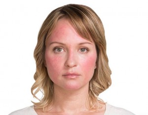 Woman with Rosacea